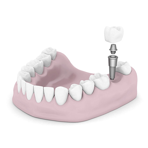 dental implant materials