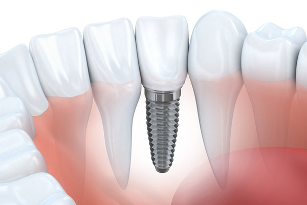 Img-dental-implant-faq-gettyimages-519555723