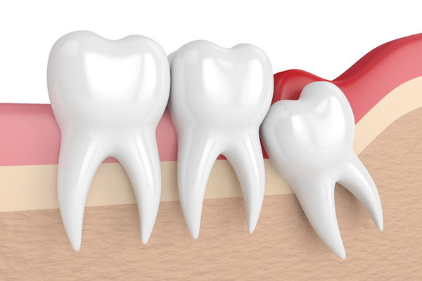 Img-wisdom-tooth-gettyimages-956382392