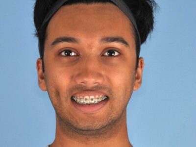 Ios-rohan-pre-op-frontal-smile-scaled