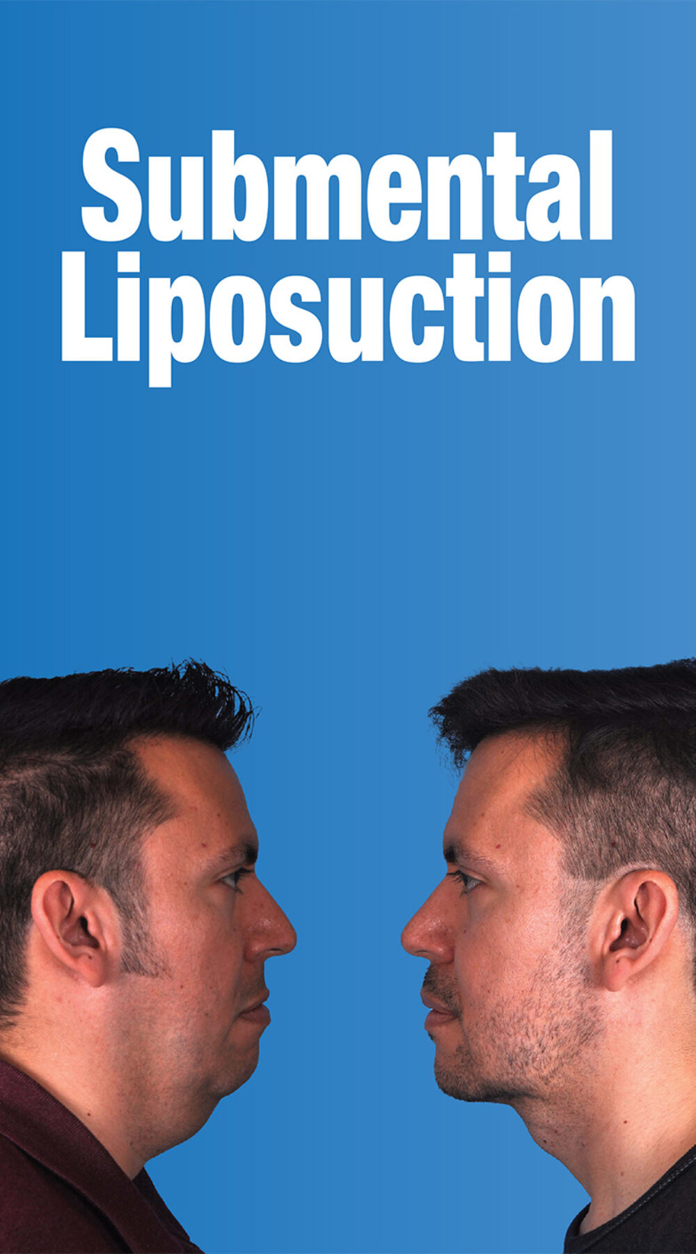 Submental Liposuction Cover Art