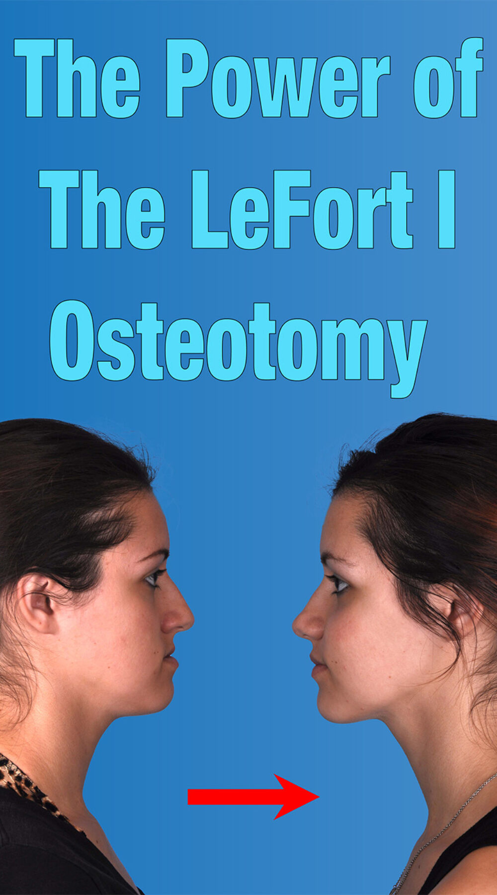 The Power of the LeFort I Osteotomy Cover