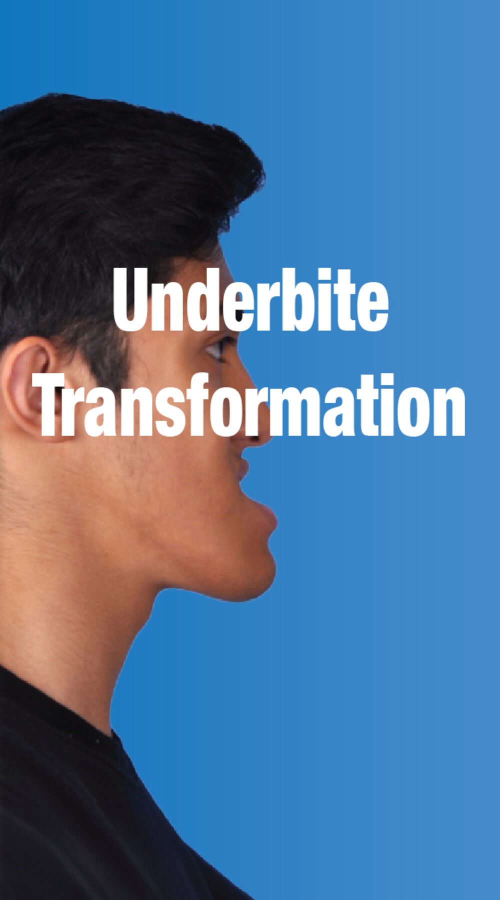 Underbite Transformation