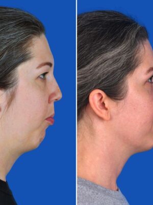 Morrison_SideImage_Mouth